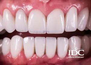 Bọc răng sứ bị thưa sau khi làm: Nguyên nhân và cách khắc phục tốt nhât