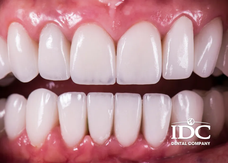 boc rang su bi viem nuou co nguy hiem