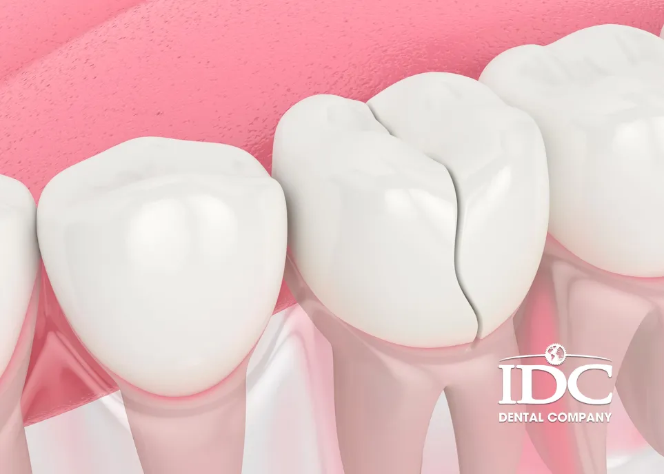 Bọc răng sứ bị vỡ có sửa được không