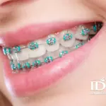 cac mon an danh cho nguoi nieng rang