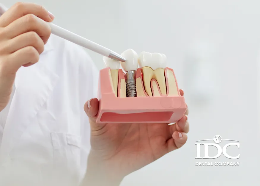 Kỹ Thuật Trồng Răng Implant Tại Nha Khoa IDC