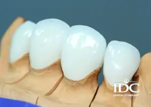 Làm răng sứ bị ê buốt nguyên nhân do đâu ? Cách nhận biết và khắc phụ hiệu quả