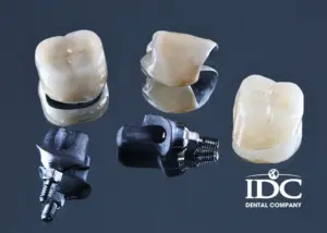 Bọc răng sứ bị sâu có thật không? Dấu hiệu nhận biết và cách điều trị