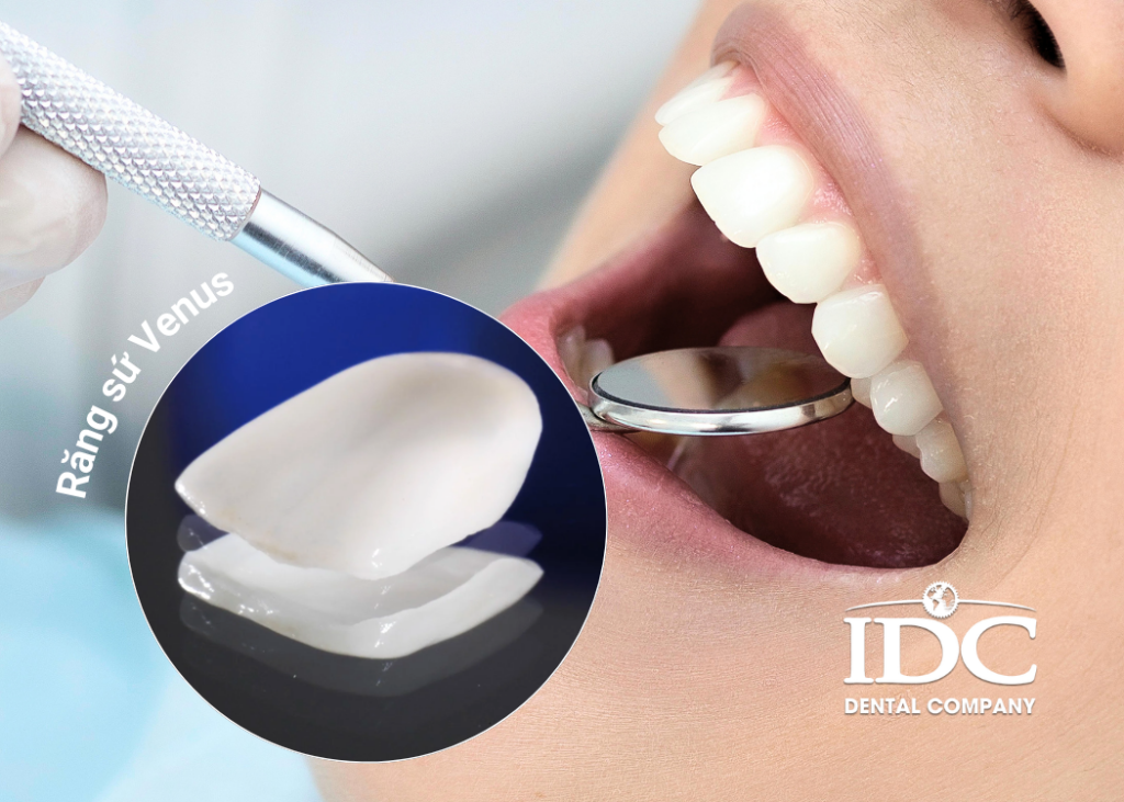 Răng sứ Venus có tốt không?
