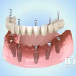 trong rang implant all on 6