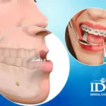 Bi mom co nen nieng rang