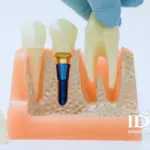 Top Dental Implant Brands Trusted by Dentists in Da Nang City