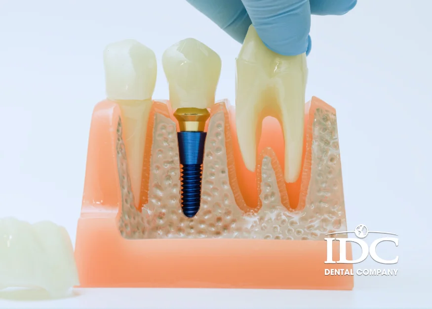 Top Dental Implant Brands Trusted by Dentists in Da Nang City