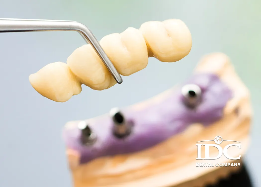 How much does a dental bridge cost compared to implants?