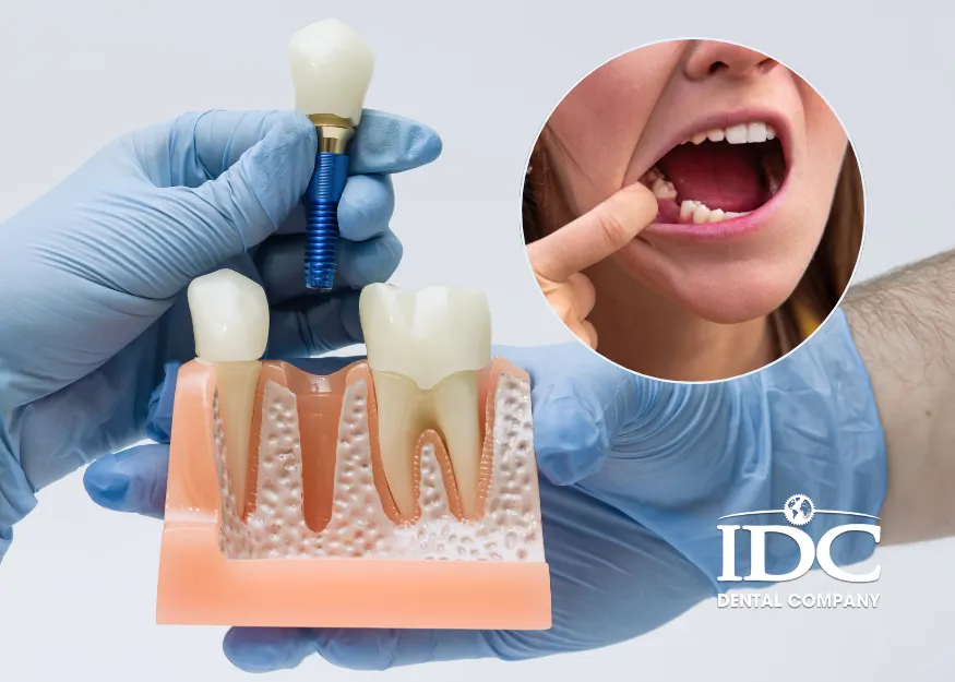 How much does it cost to replace a missing tooth