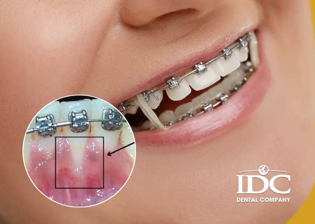 Nguyên nhân khiến tụt lợi khi niềng răng