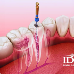 Where Can I Get Pain-Free Root Canal Treatment in Da Nang City?