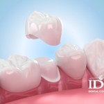 Review 5 Porcelain Dental Crown Addresses in Da Nang City