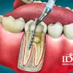 The Best Dental Clinics for Root Canal Treatment in Da Nang 2