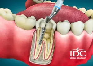 The Cost of Dental Fillings in Danang, Vietnam: Everything You Need to Know