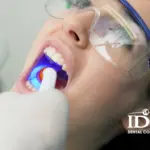 The Cost of Dental Fillings in Danang, Vietnam