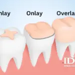 a Dental InlayOnlay