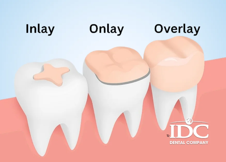 a Dental InlayOnlay
