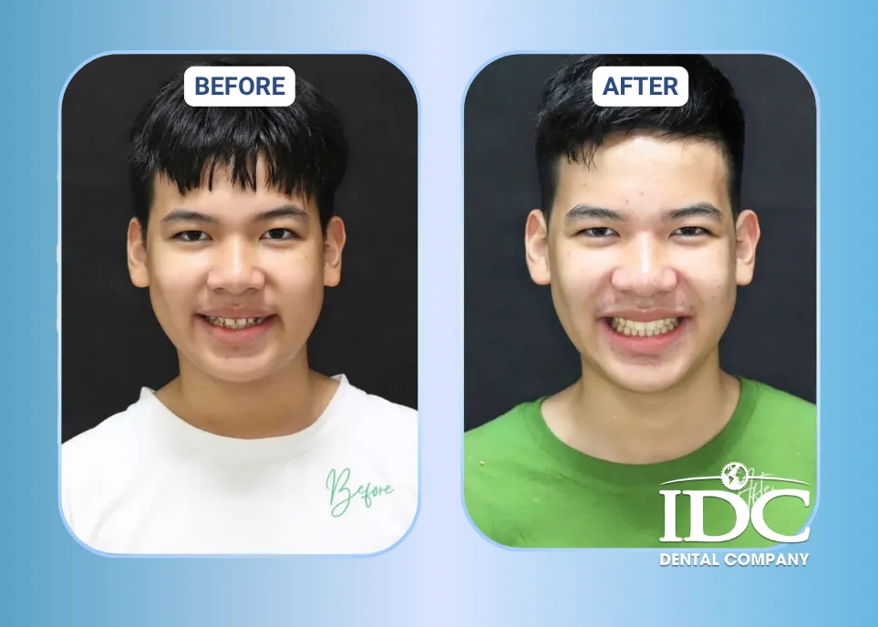 anh thuc te nieng rang invisalign 2
