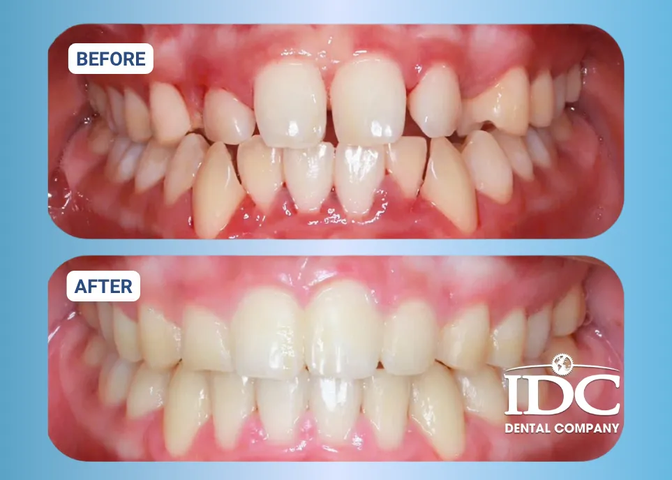 anh thuc te nieng rang invisalign