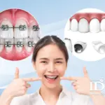 Bị mất răng hàm có niềng răng được không?