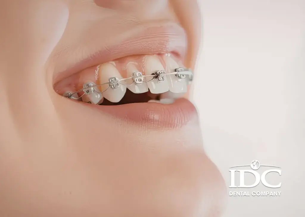 Niềng răng có gây tụt lợi không?