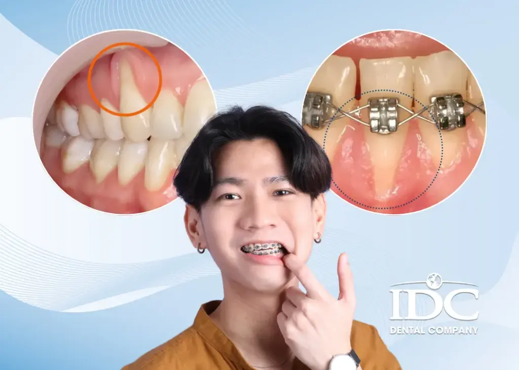 Bị tụt lợi khi niềng răng có sao không?