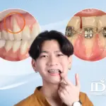 Bị tụt lợi khi niềng răng có sao không?