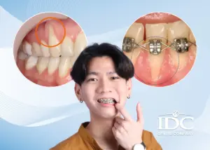 Bọc cầu răng sứ là gì? Giải pháp phục hình hiệu quả khi mất răng