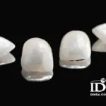 Bọc 2 răng cửa tại Đà Nẵng giá bao nhiêu?