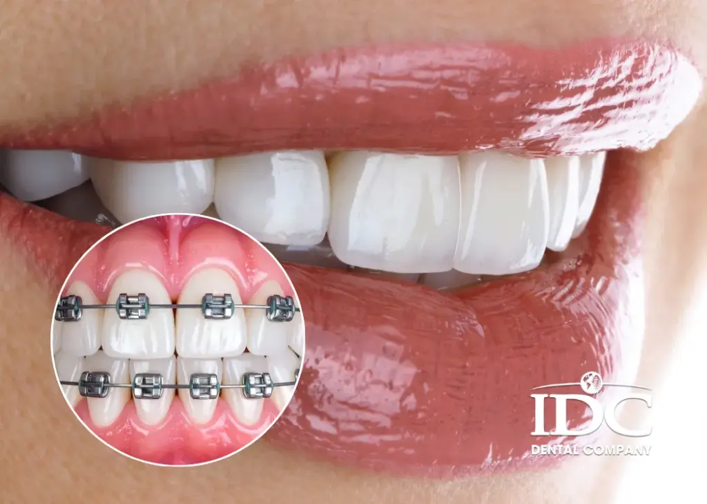 Bọc răng sứ có niềng răng