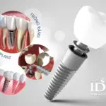 Cấy ghép răng implant loại nào tốt nhất hiện nay?