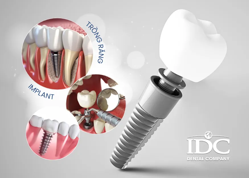 Cấy ghép răng implant loại nào tốt nhất hiện nay?