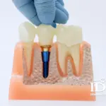 Chi phí làm 1 răng implant bao nhiêu tiền?
