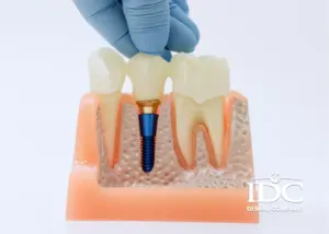 9 Lưu ý khi niềng răng để đạt được hiệu quả cao