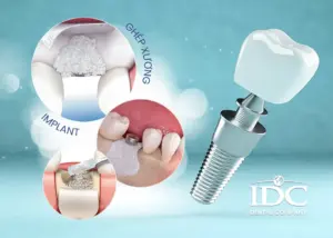 Cấy ghép răng implant loại nào tốt nhất hiện nay?