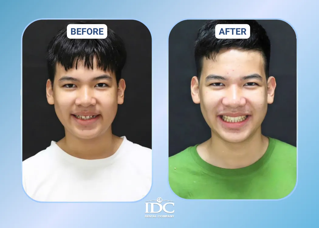invisalign 1