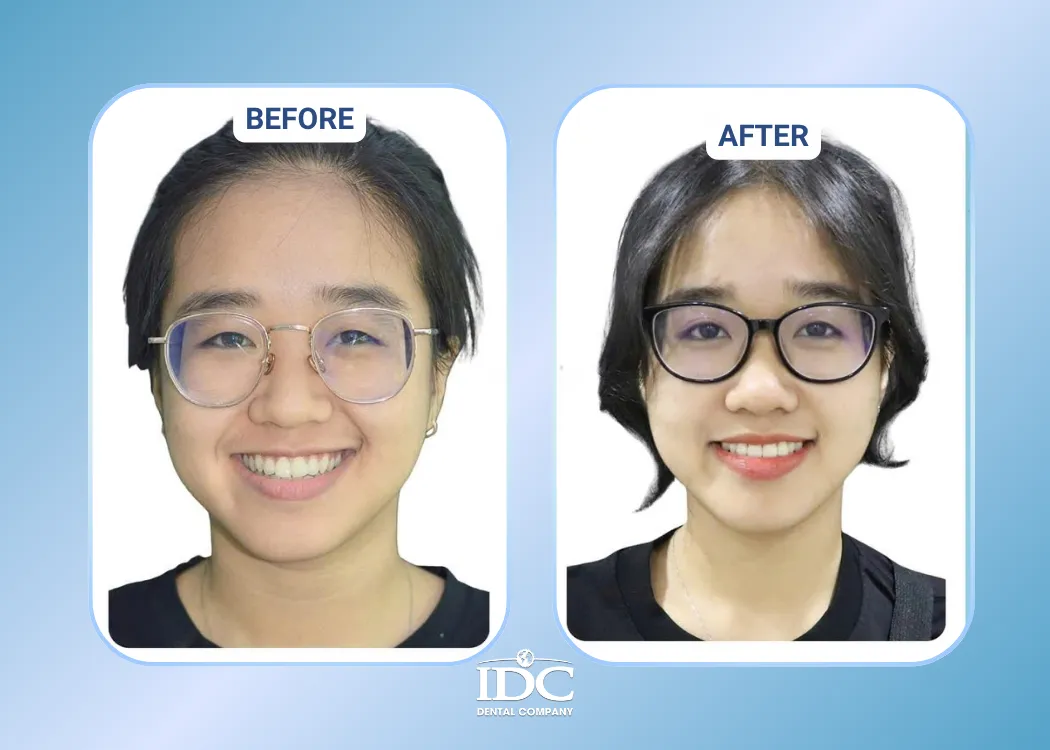 invisalign 3