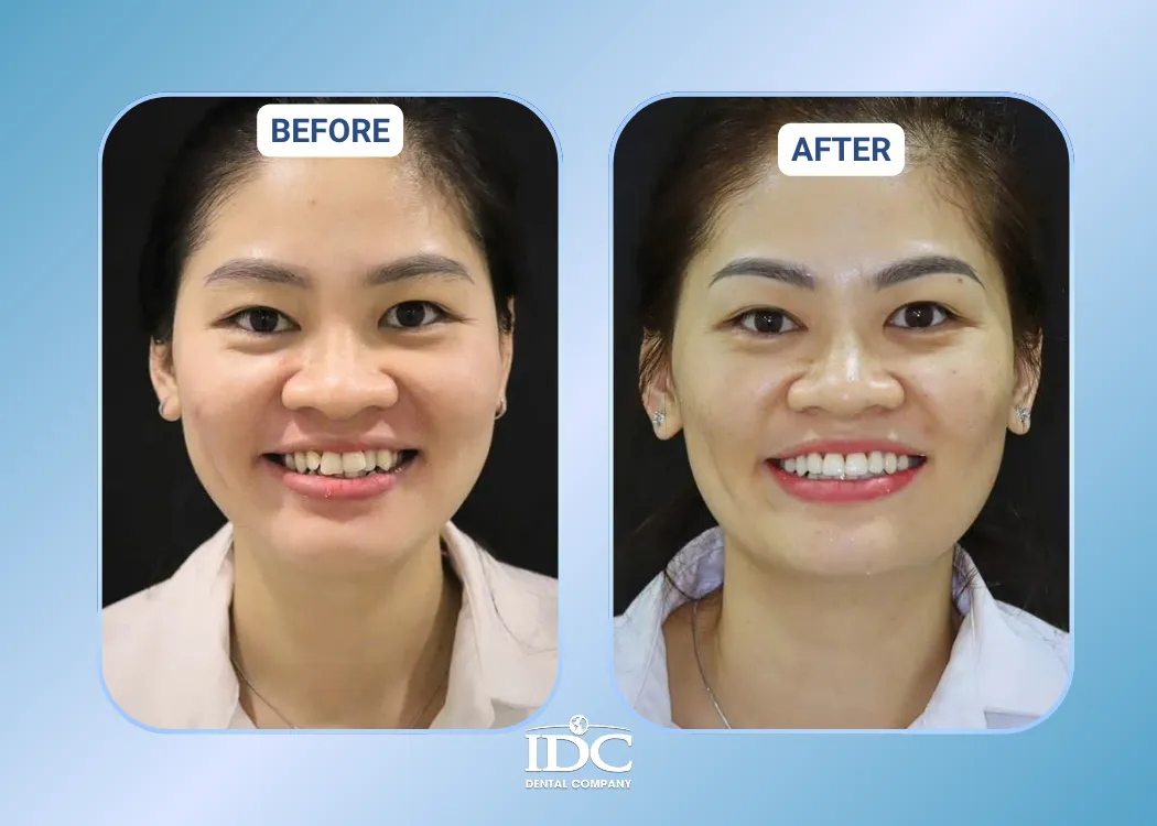 invisalign 4