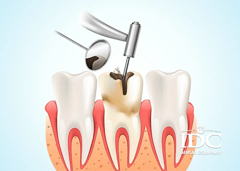 Làm răng sứ có lấy tủy khi răng bị sâu nặng