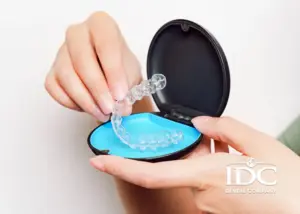 Chi phí làm 1 răng implant bao nhiêu tiền?