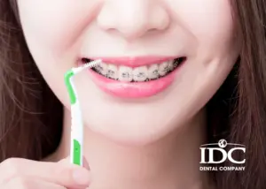 Bị hô hàm trên có niềng răng được không? Bác sĩ giải đáp chi tiết