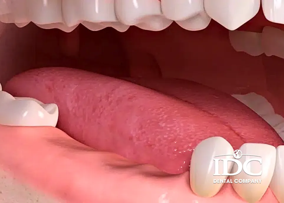 Nguyên nhân gây tiêu xương hàm