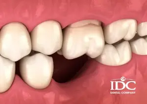 Các loại niềng răng không mắc cài được ưa chuộng