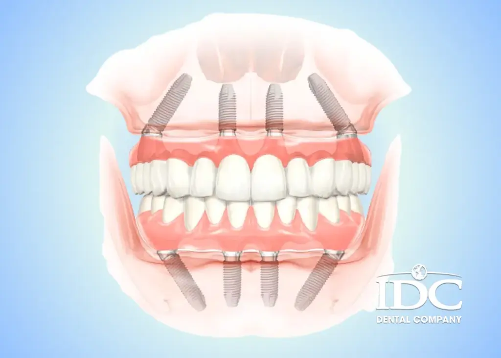 Trồng răng implant All-on-4 là gì?