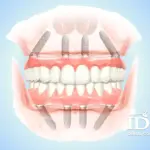 Trồng răng implant All-on-4 là gì?