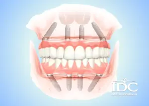 Trồng răng implant All-on-4 là gì?