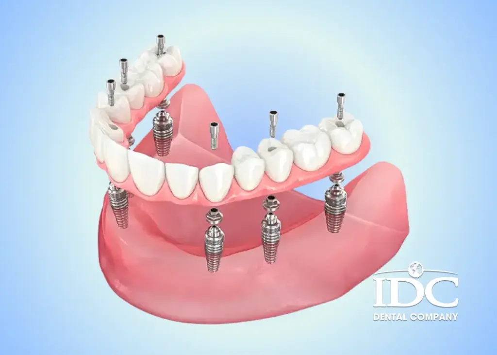 Trồng răng implant All-on-6 là gì?
