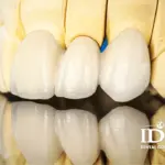 trong rang su cao cap co gi khac so voi rang su thuong