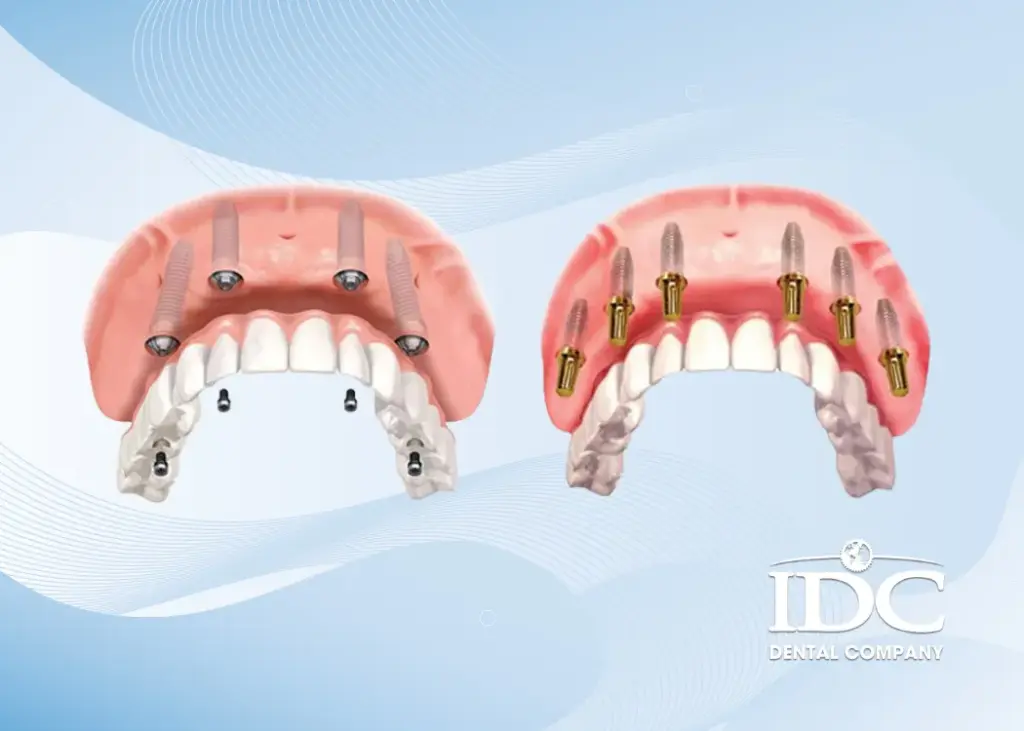 Trồng răng toàn hàm bằng implant